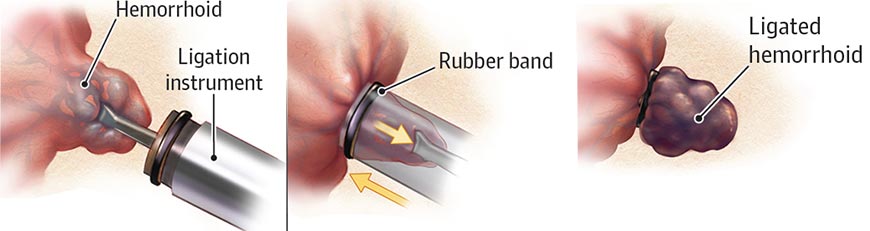 hemorrhoid banding